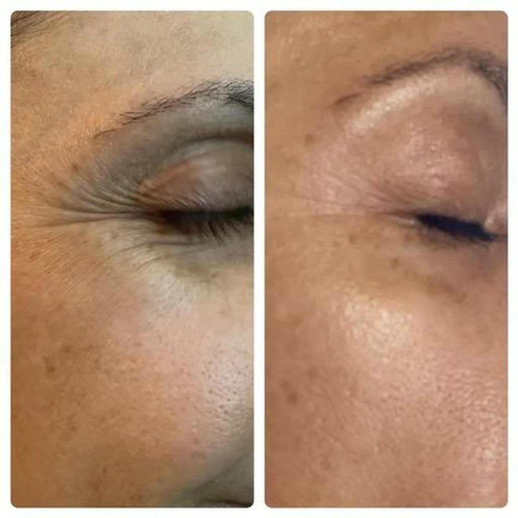 The Before and After of Microneedling Treatment