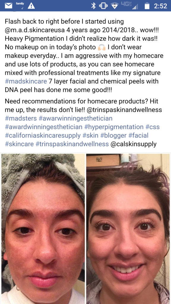 Mad Skincare Chemical Peel Before and After Testimonial