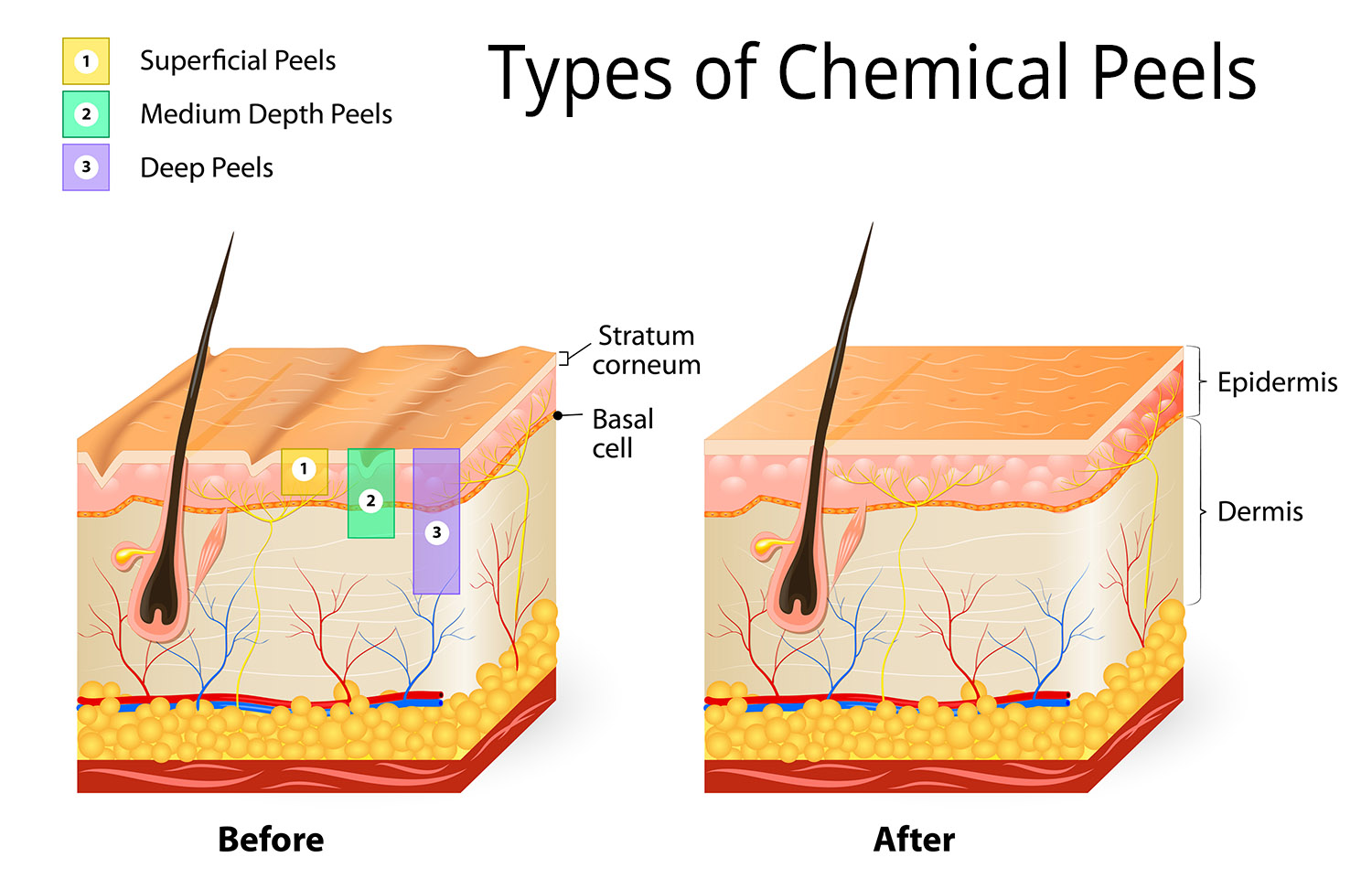 Types of chemical peels