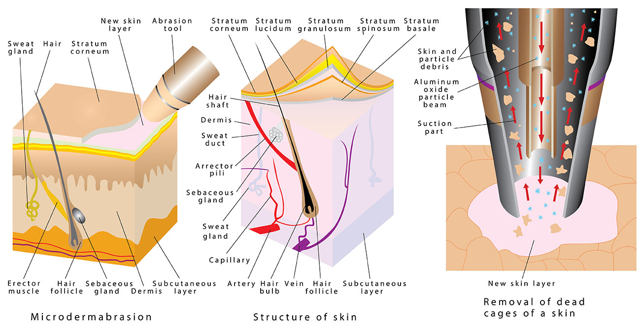 What is microdermabrasion?