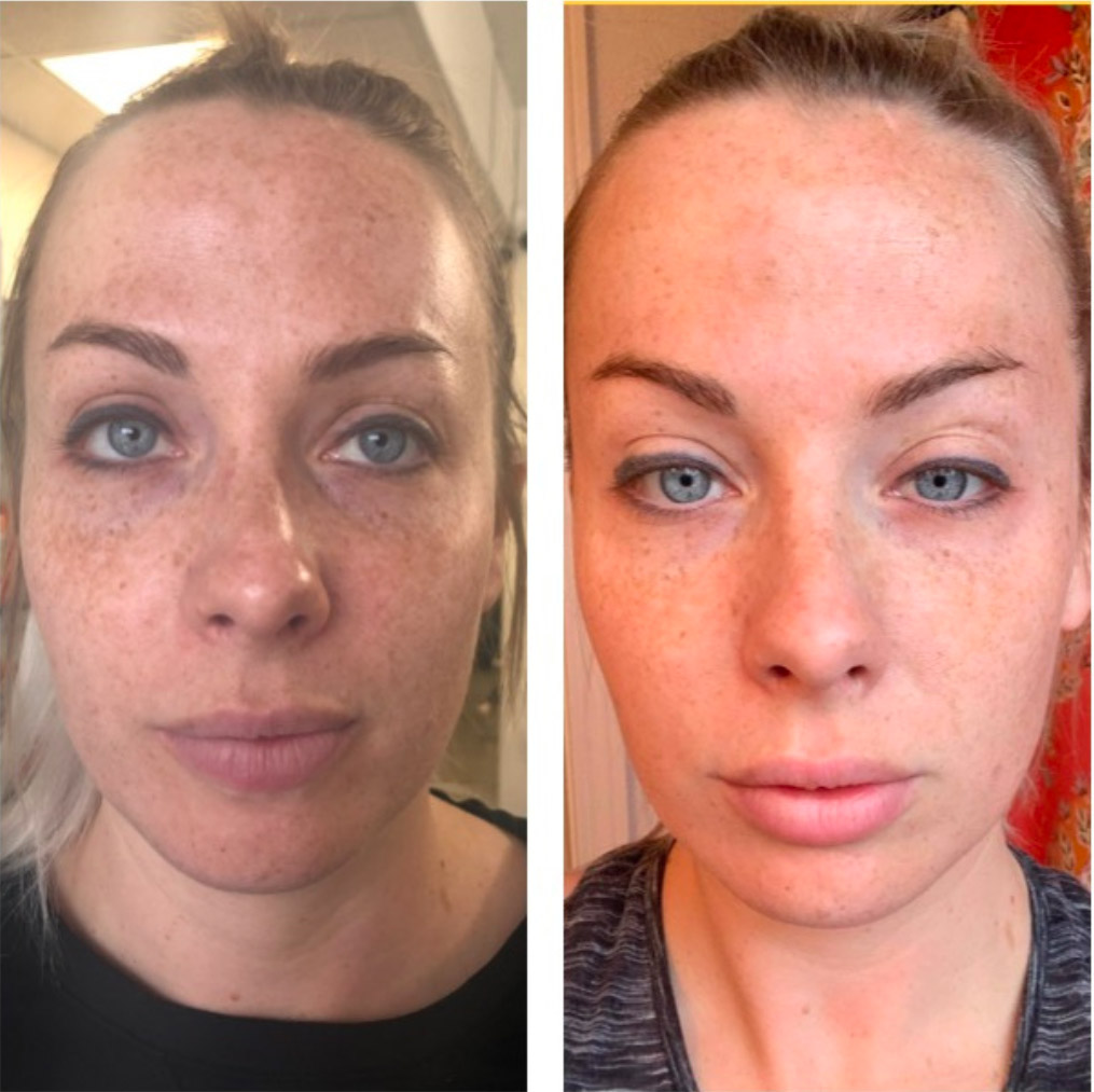 microneedling before and after picture