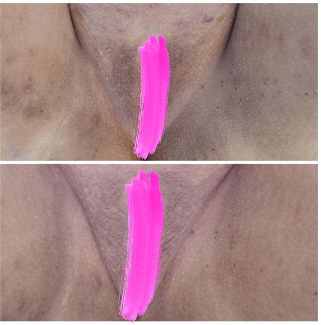 Before and after skin brightening vaginal area