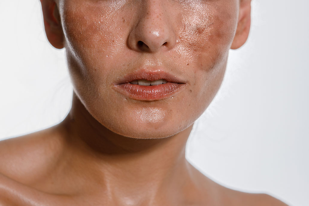 Triggered, remedies and preventions of broken pores and skin barrier