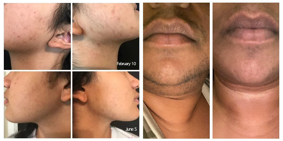Before and after pictures of a woman's and a man's face after hair removal with epilfree